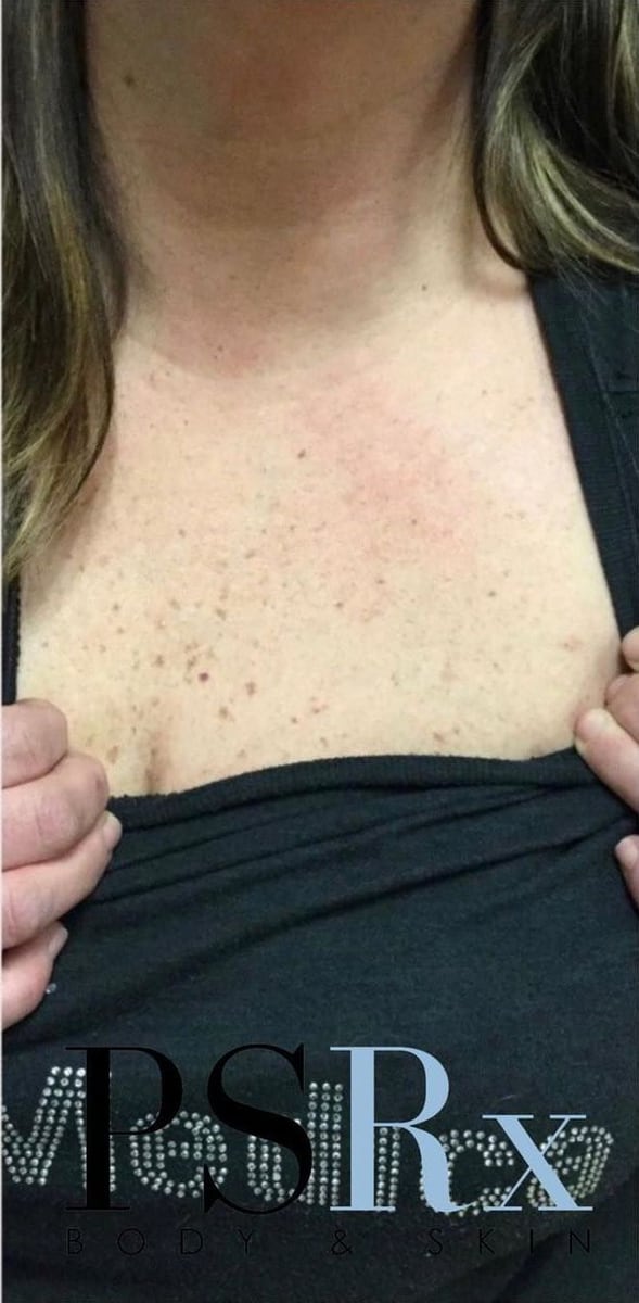 After: Tattoo removal, chest