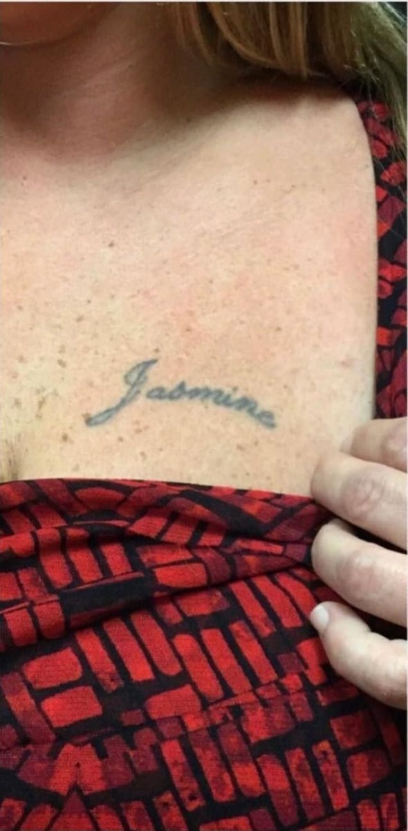Before: Tattoo removal, chest