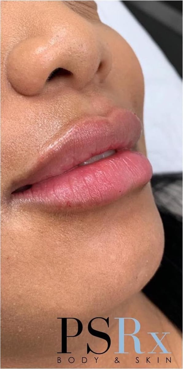 After: Filler, lips