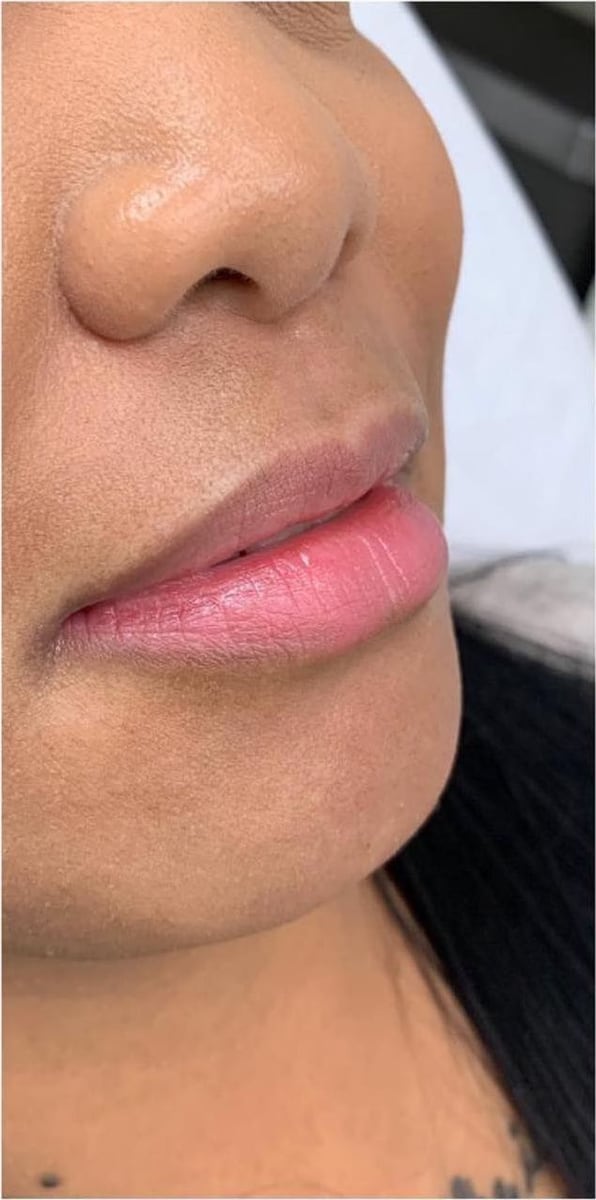 Before: Filler, lips