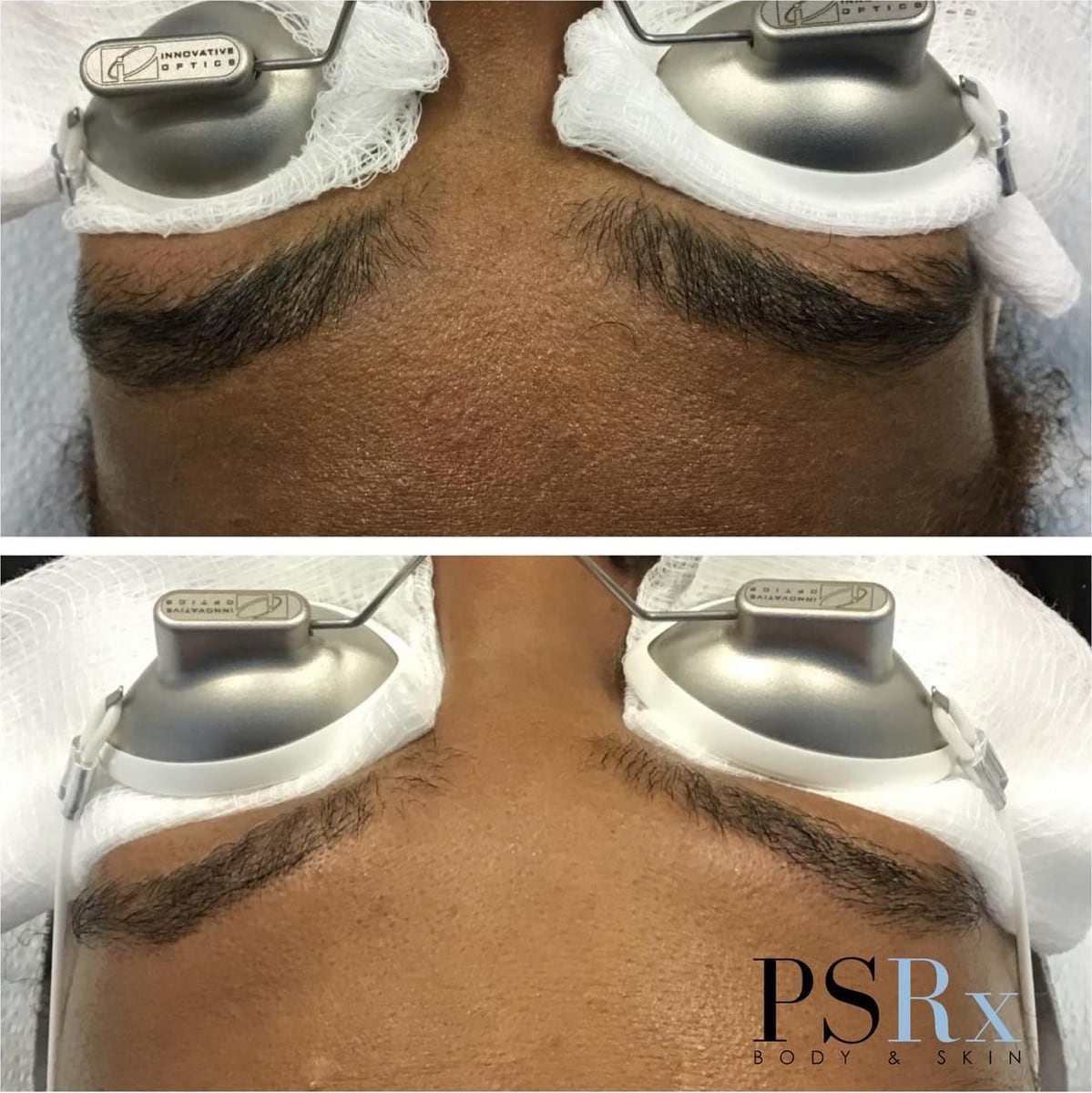 Before and after: Tattoo removal, brows