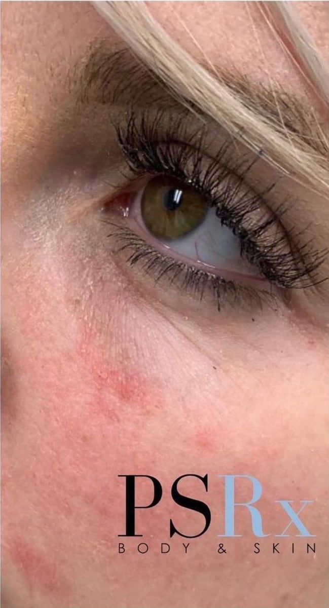 After: Filler, under the eyes