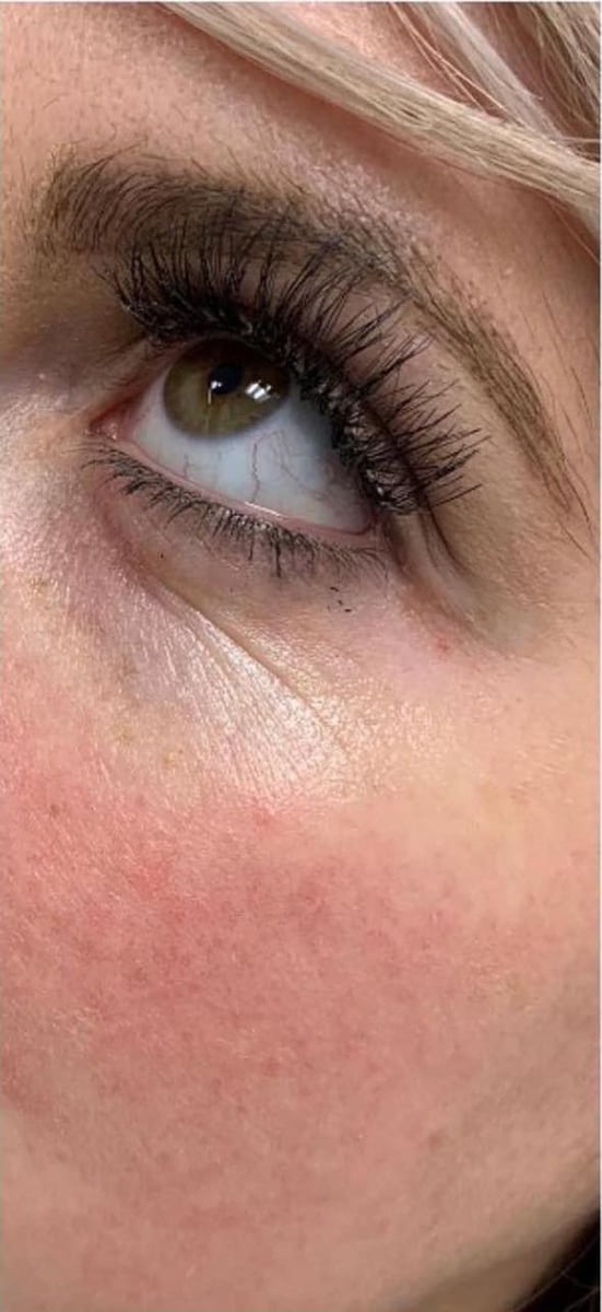 Before: Filler, under the eyes