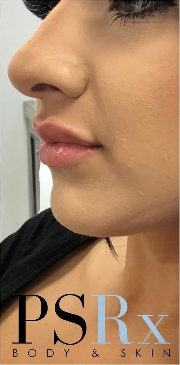After: Filler, lips