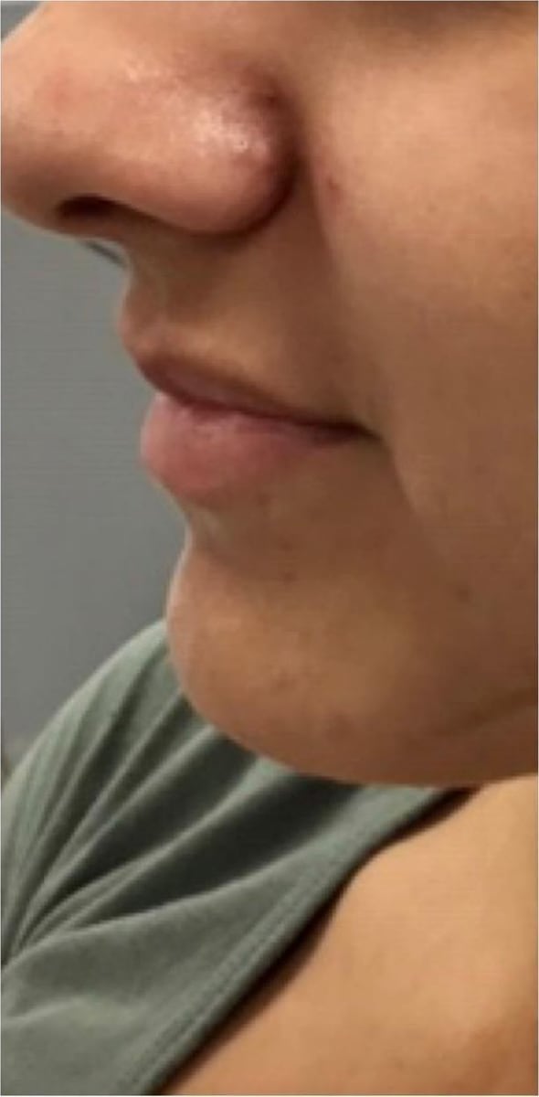 Before: Filler, lips