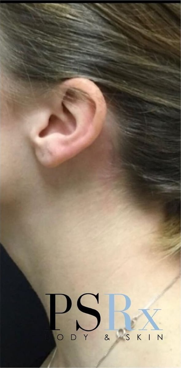After: Tattoo removal, neck