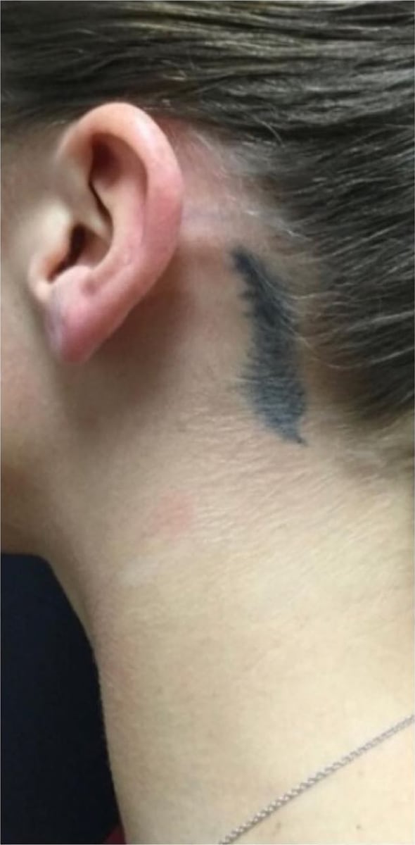 Before: Tattoo removal, neck