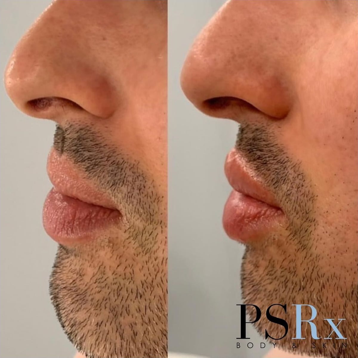 Before and after: Filler, lips