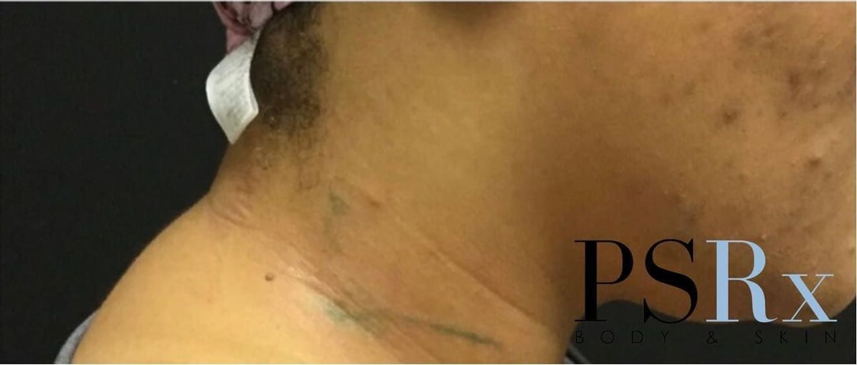 After: Tattoo removal, neck