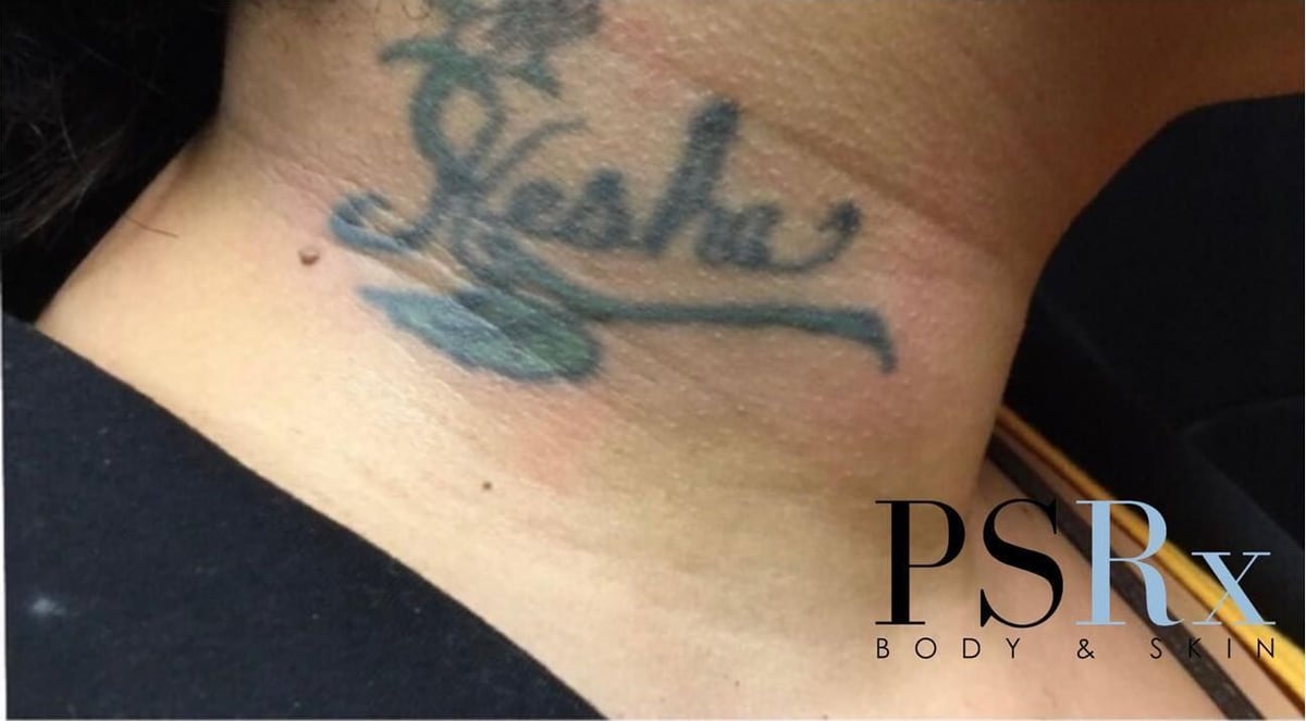Before: Tattoo removal, neck