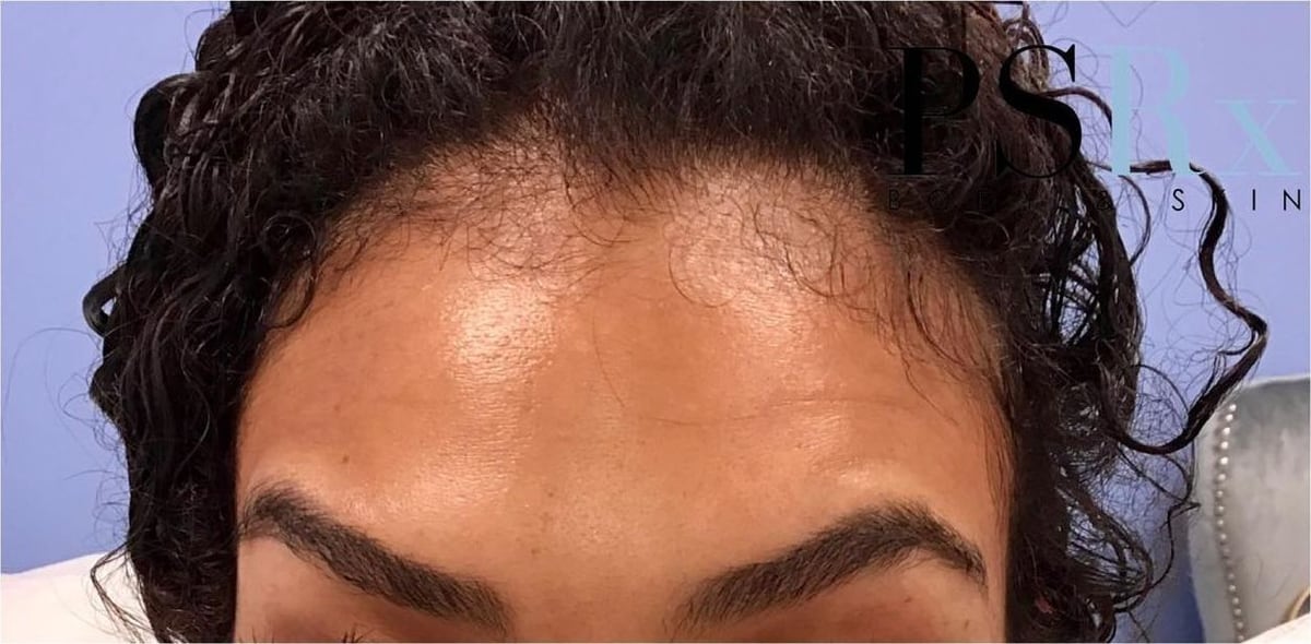 After: Neurotoxin, forehead