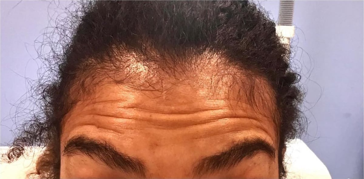 Before: Neurotoxin, forehead