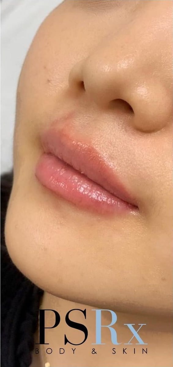 After: Filler, lips