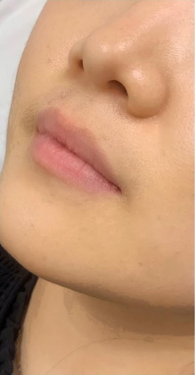 Before: Filler, lips