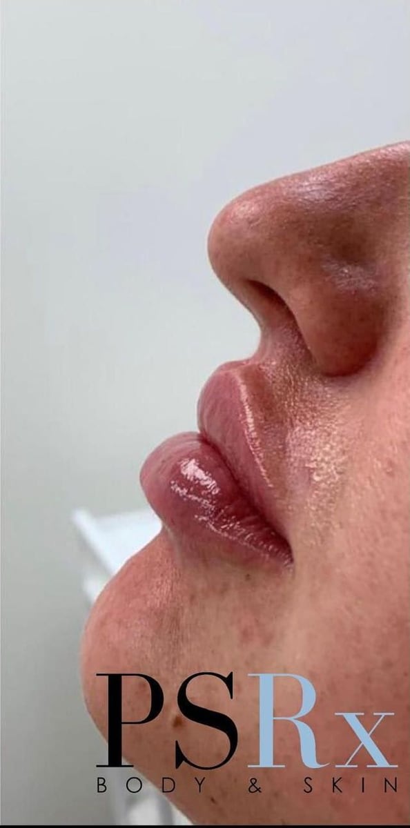 After: Filler, lips