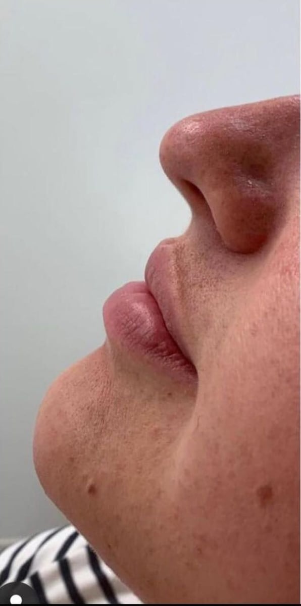 Before: Filler, lips