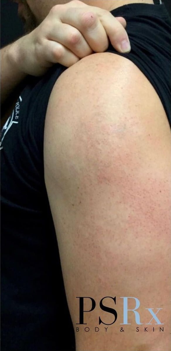 After: Tattoo removal, arm