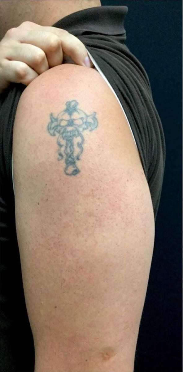 Before: Tattoo removal, arm