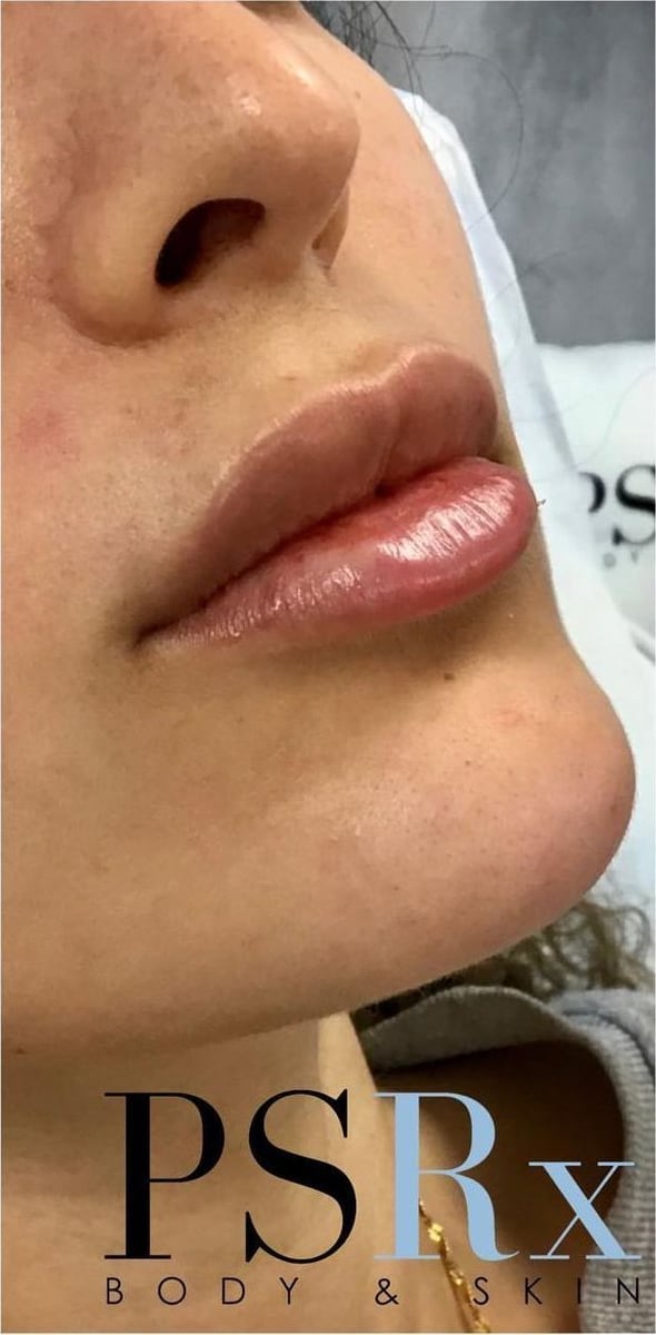 After: Filler, lips