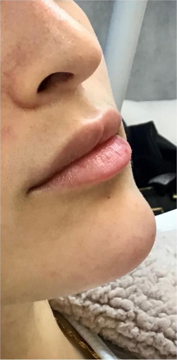 Before: Filler, lips