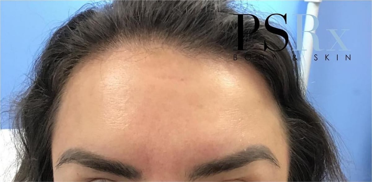 After: Neurotoxin, forehead