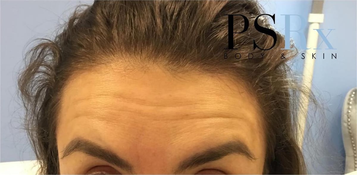 Before: Neurotoxin, forehead