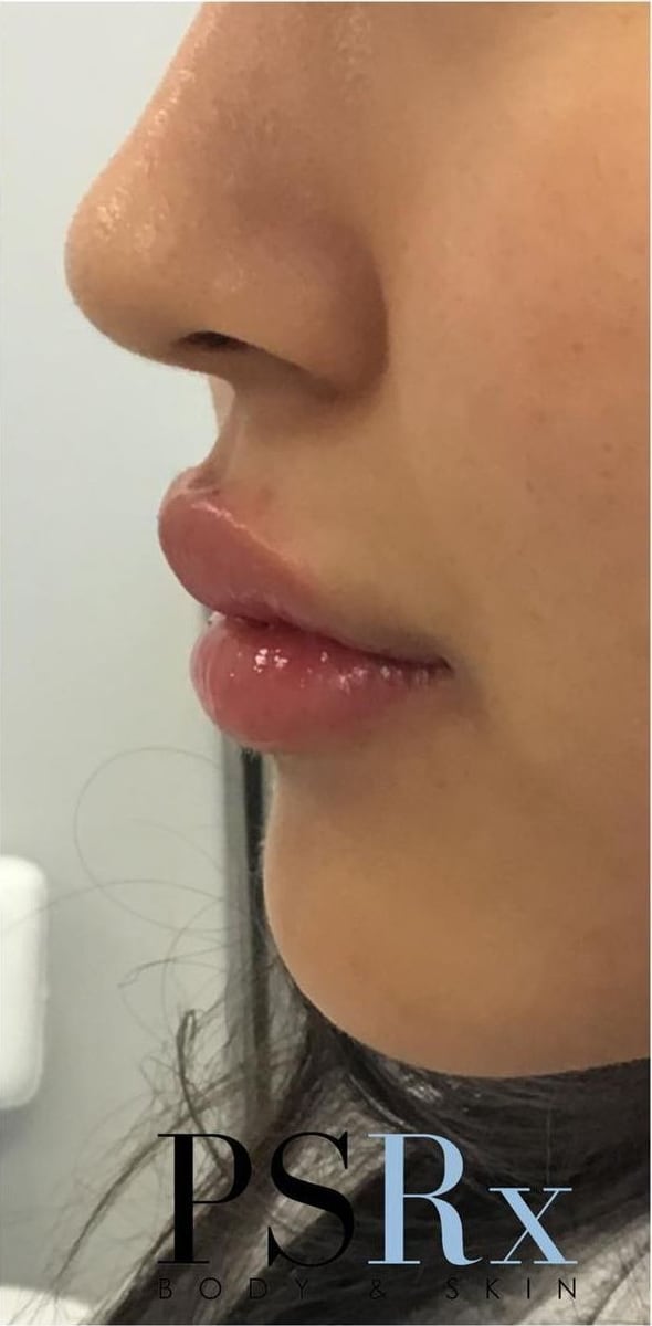 After: Filler, lips