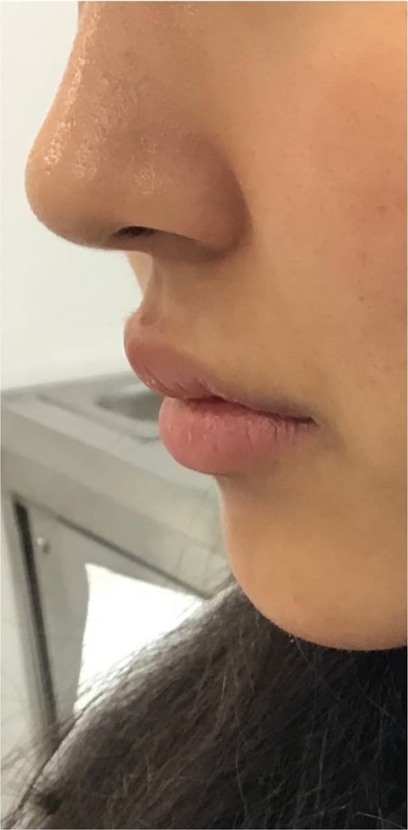 Before: Filler, lips