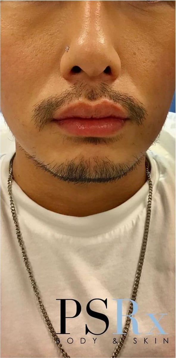 After: Filler, lips
