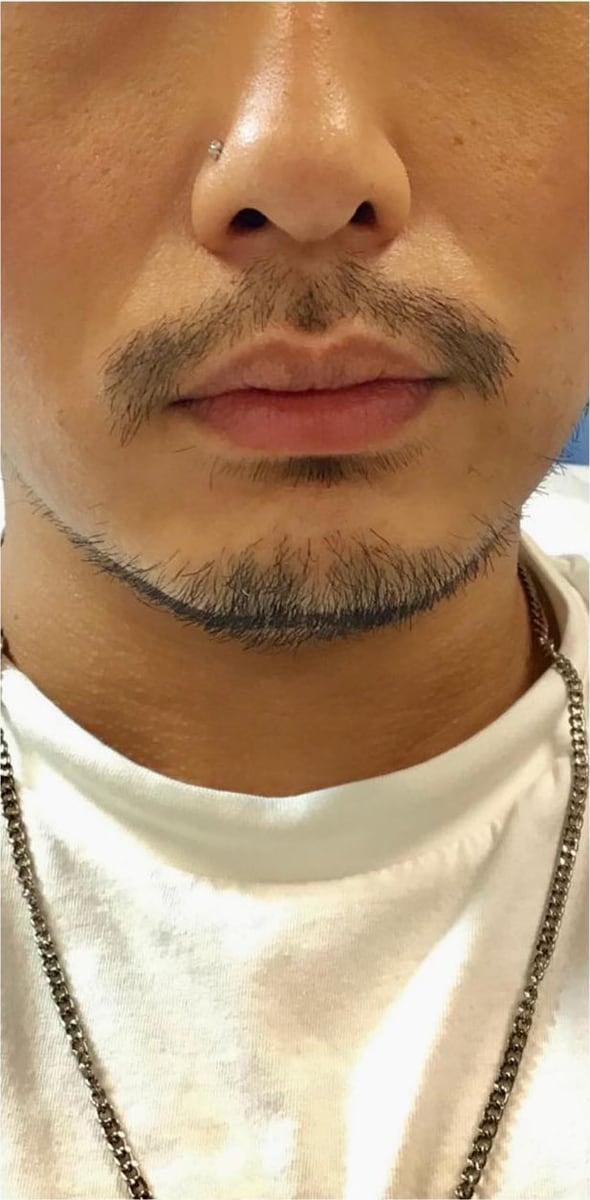 Before: Filler, lips