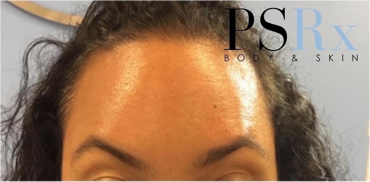 After: Neurotoxin, forehead