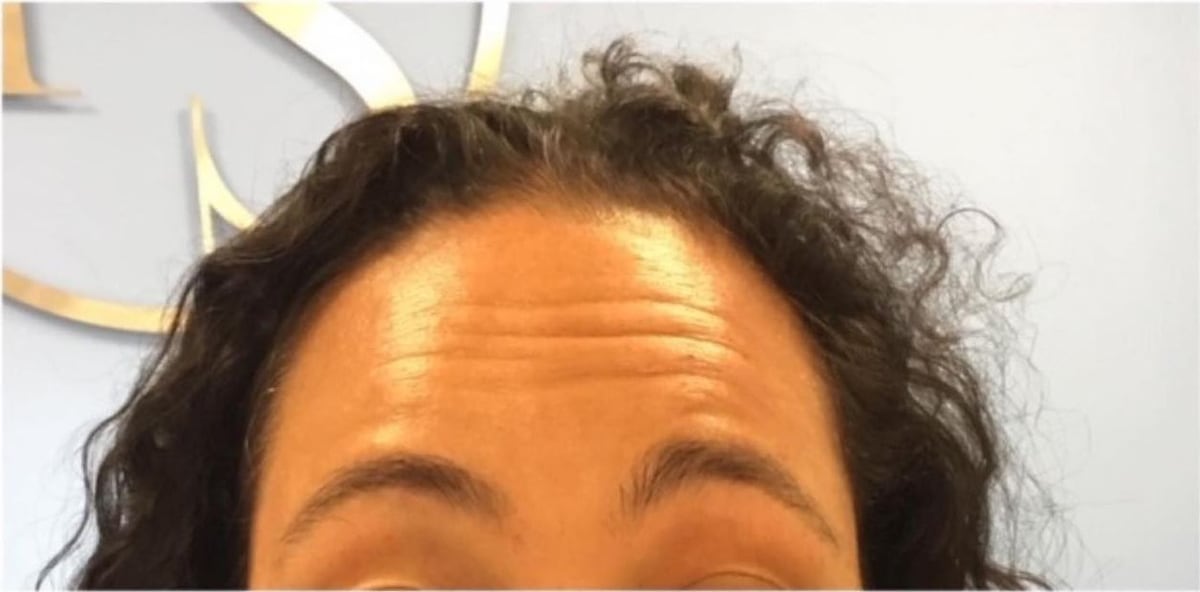 Before: Neurotoxin, forehead