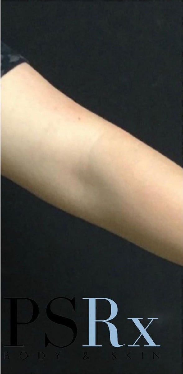 After: Tattoo removal, arm