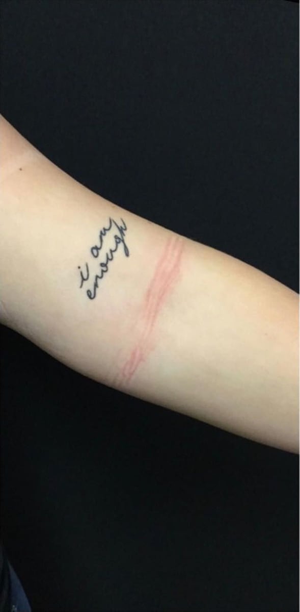Before: Tattoo removal, arm