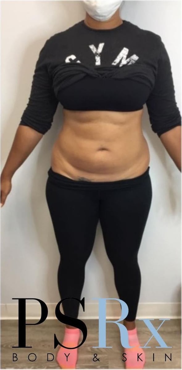 After: Body contouring, abdomen