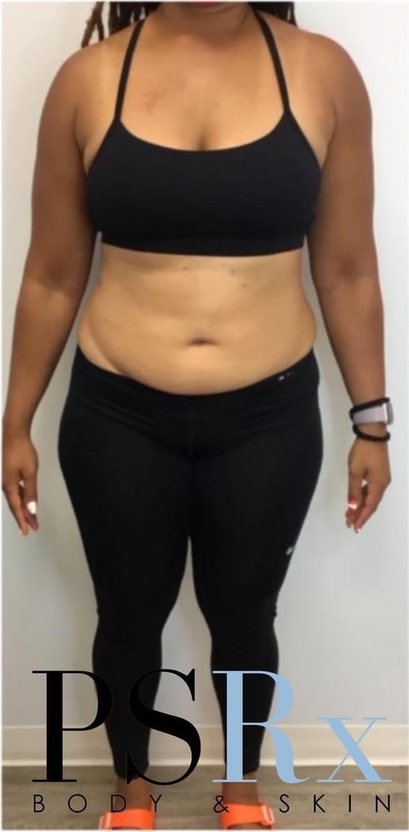 Before: Body contouring, abdomen