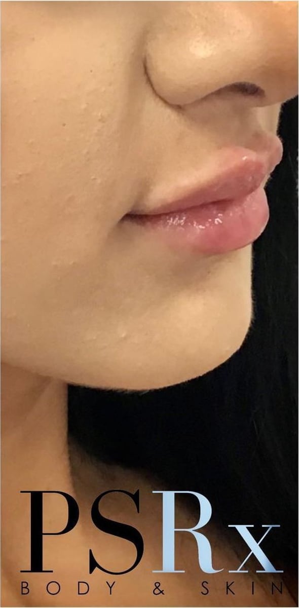 After: Filler, lips
