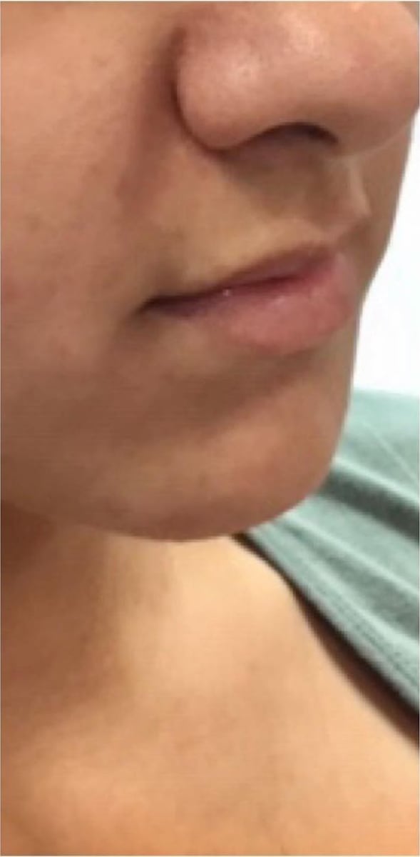 Before: Filler, lips