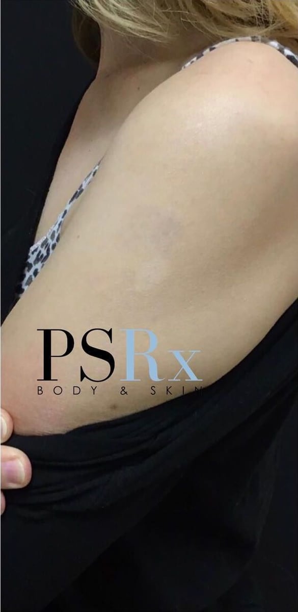 After: Tattoo removal, arm