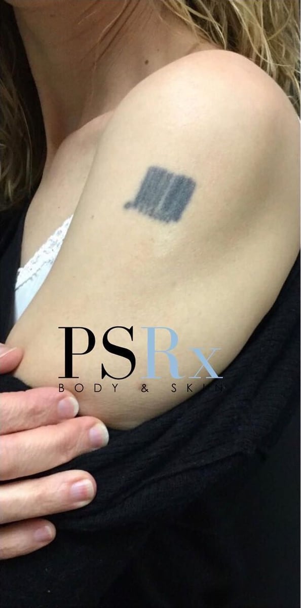 Before: Tattoo removal, arm
