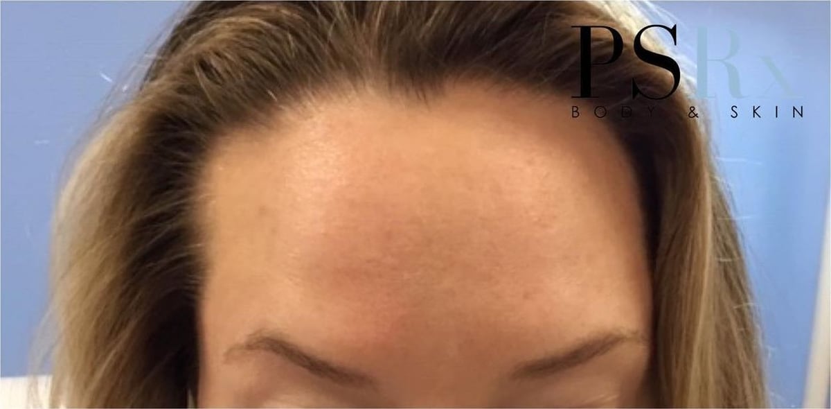 After: Neurotoxin, forehead