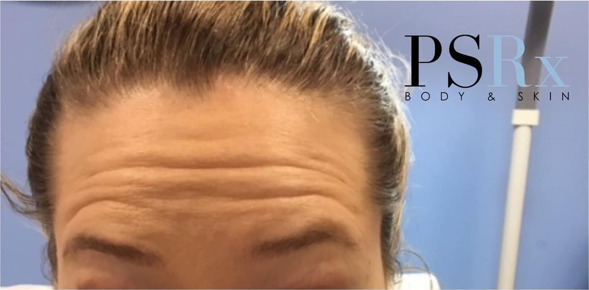 Before: Neurotoxin, forehead