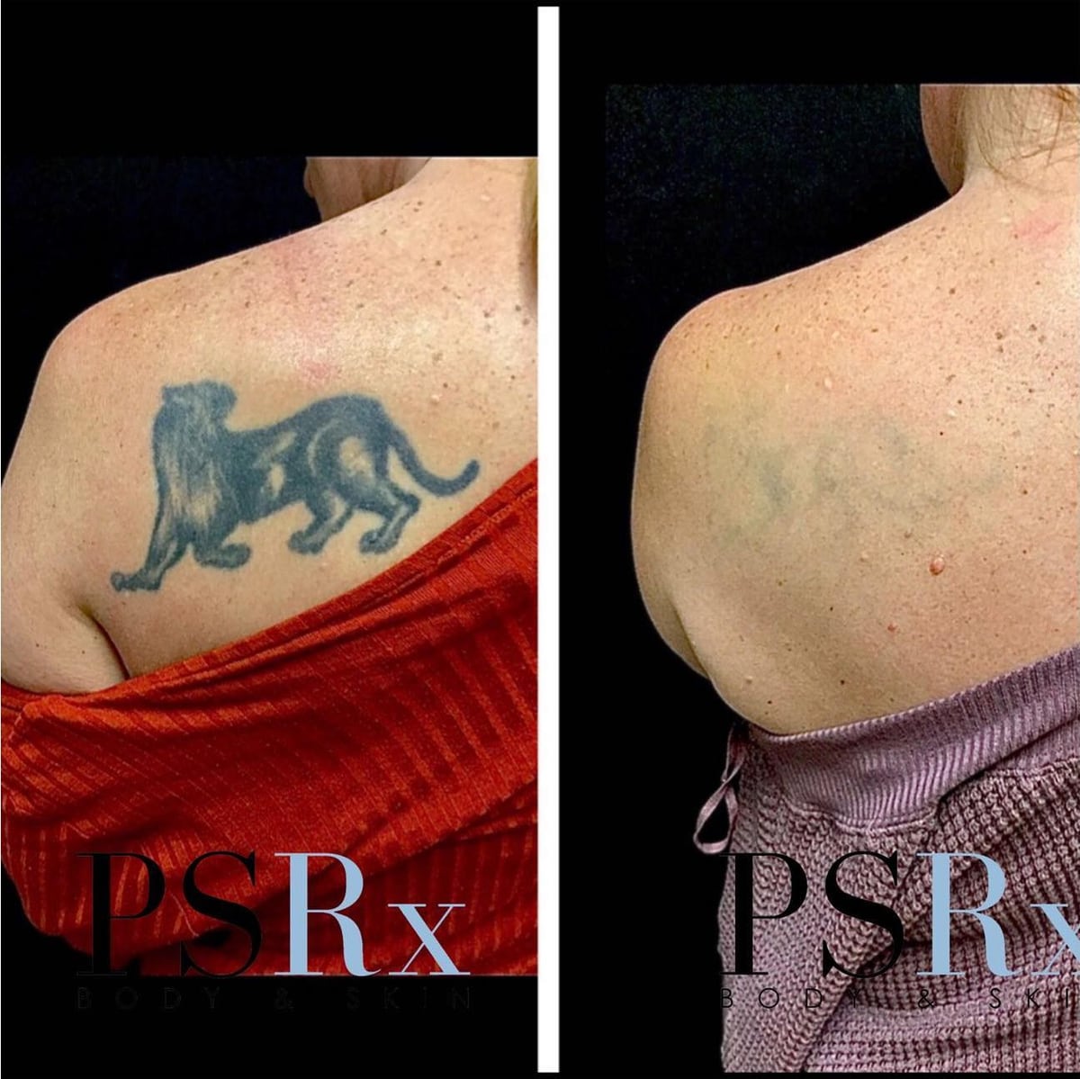 Before and after: Tattoo removal, back