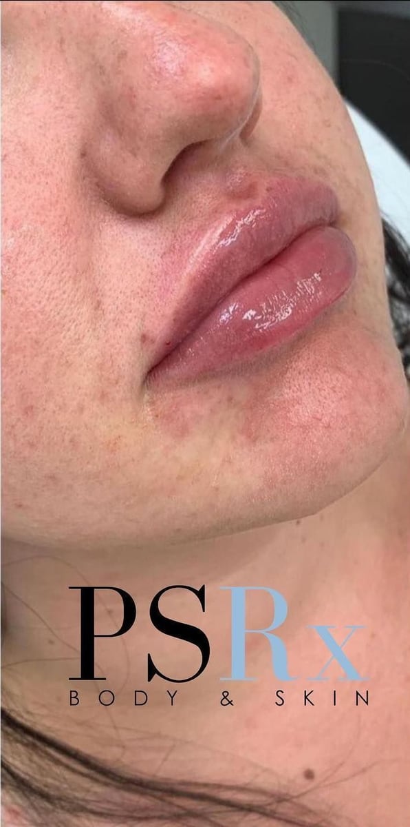 After: Filler, lips