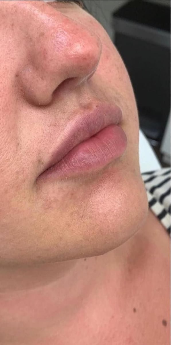 Before: Filler, lips
