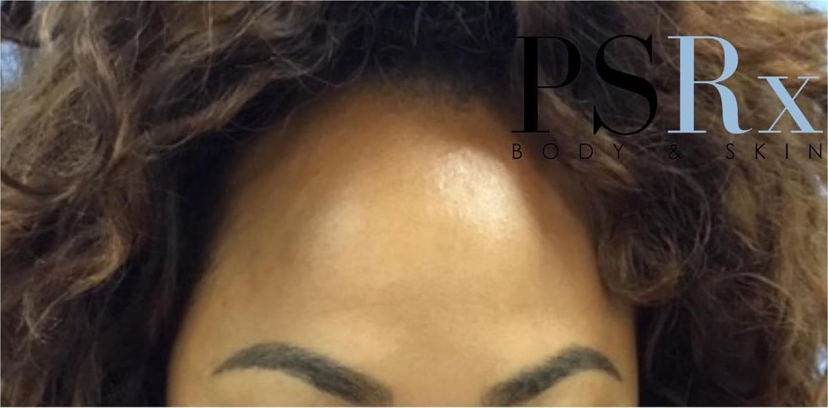 After: Neurotoxin, forehead