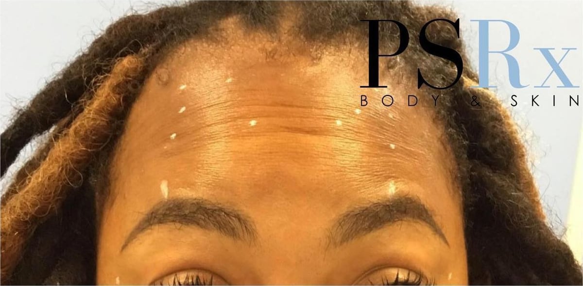 Before: Neurotoxin, forehead