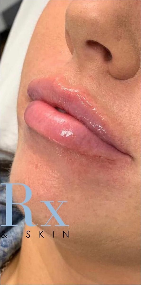 After: Filler, lips