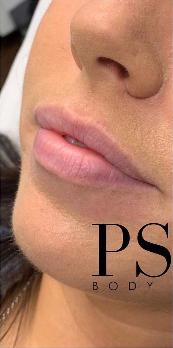 Before: Filler, lips