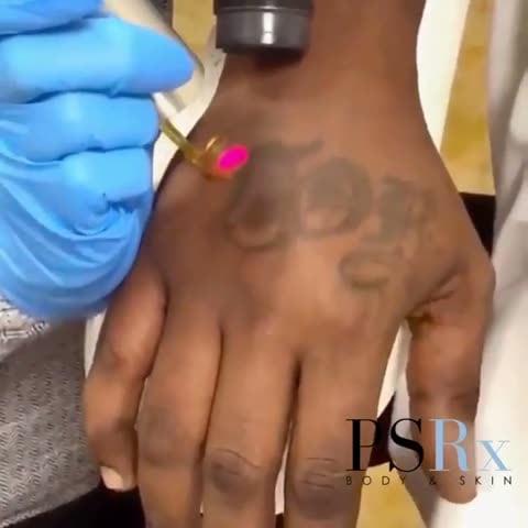 Before: Tattoo removal, hand